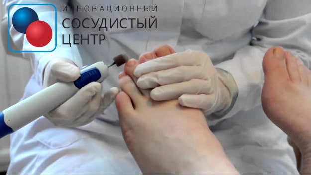 Правильный уход за стопами при диабете