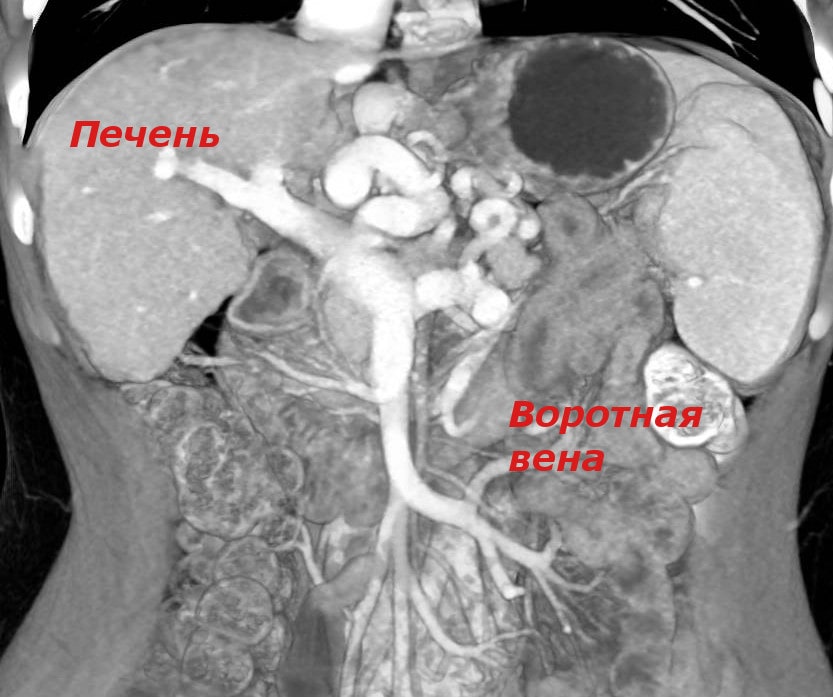 Компьютерная ангиография системы воротной вены
