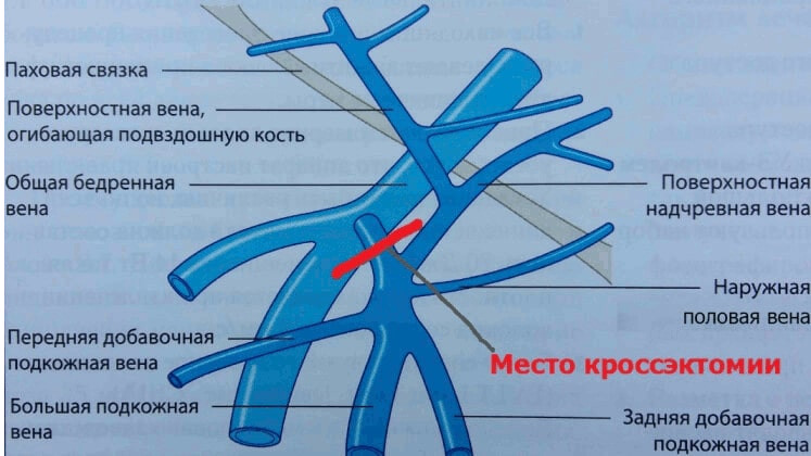 Схема операции кроссэктомии