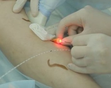 Лазер останавливает процесс тромбофлебита