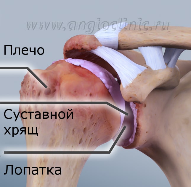 Артроз плечевого сустава