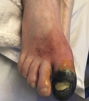 Гангрена большого пальца