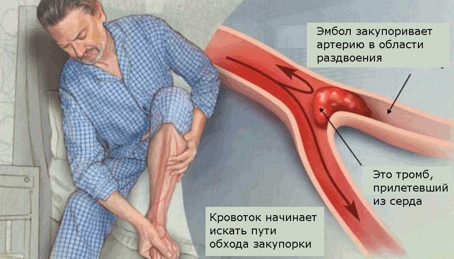 Эмболия является одной из частых причин острой артериальной недостаточности