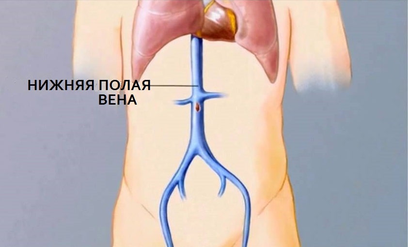 Нижняя полая вена - крупнейший сосуд отводящий венозный сосуд организма