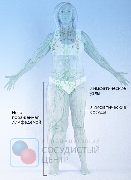 Лимфостаз ноги