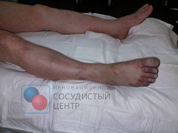 Острая ишемия правой нижней конечности при тромбозе подколенной аневризмы