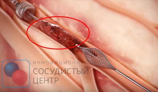 Удаление тромбов из сосудов