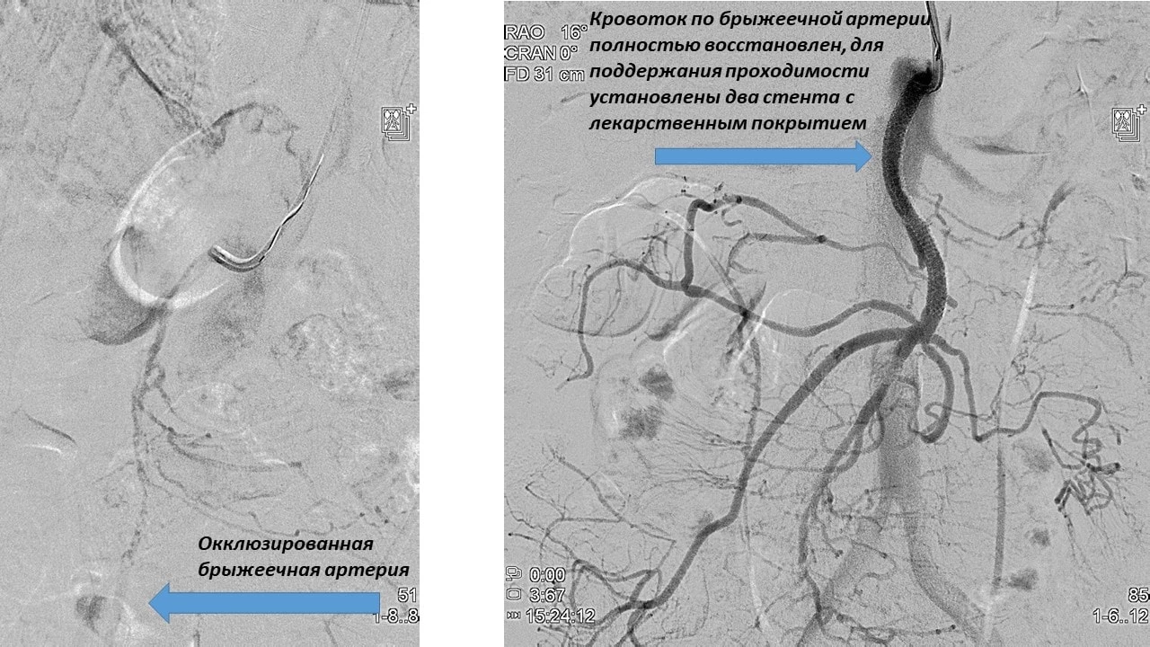 Ангиопластика и стентирование верхней брыжеечной артерии