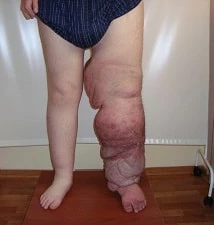 Эпикриз