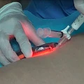 Использование пенной склеротерапии вместе с лазером для устранения крупных варикозных притоков