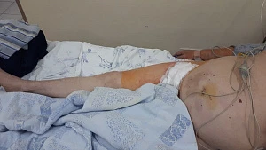 Эндоваскулярное лечение закупорки подвздошной артерии больному с ожирением
