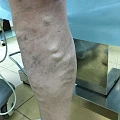 Интересный результат лазерного лечения варикоза с минифлебэктомией