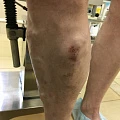 Лазерное лечение варикоза и флебэктомия с отдаленным результатом